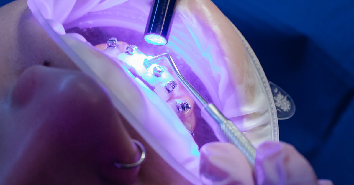 Close-up of a dental procedure using a UV light on braces for orthodontic treatment.